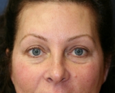 Feel Beautiful - Eyelid Surgery San Diego Case 50 - Before Photo